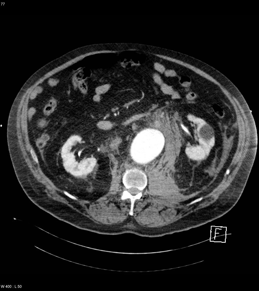 Abdominal aortic aneurysm with intramural hematoma then rupture (Radiopaedia 50278-55632 Axial C+ arterial phase 76).jpg