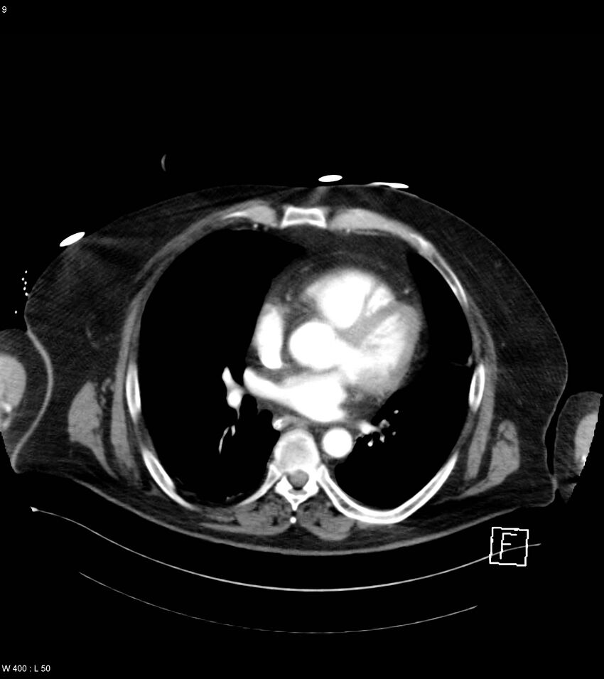 Abdominal aortic aneurysm with intramural hematoma then rupture (Radiopaedia 50278-55632 Axial C+ arterial phase 8).jpg
