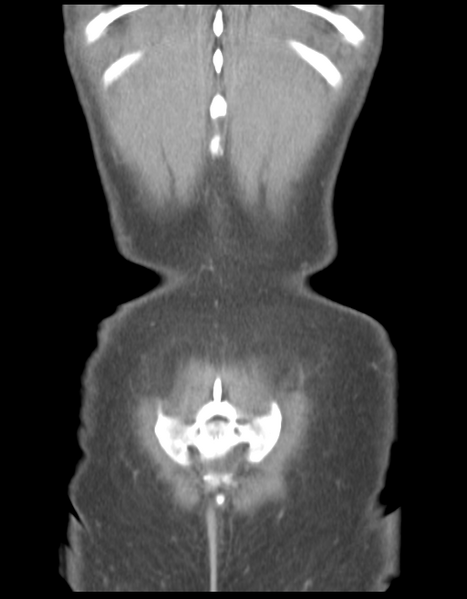 File:Abdominal desmoid tumor (Radiopaedia 41007-43740 Coronal C+ portal venous phase 39).png