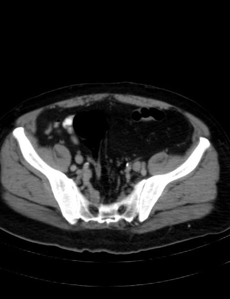 File:Abdominal lymphoma - with sandwich sign (Radiopaedia 53486-59492 Axial C+ portal venous phase 40).jpg