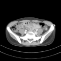 Abdominal multi-trauma - devascularised kidney and liver, spleen and pancreatic lacerations (Radiopaedia 34984-36486 Axial C+ portal venous phase 58).png