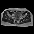 Abdominal wall endometriosis (Radiopaedia 83702-98847 Axial T2 10).jpg