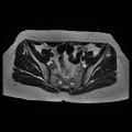 Abdominal wall endometriosis (Radiopaedia 83702-98847 Axial T2 6).jpg