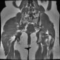 Abdominal wall endometriosis (Radiopaedia 83702-98847 Coronal T1 14).jpg