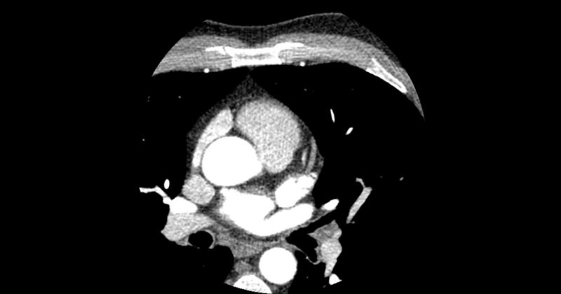 File:Aberrant left main coronary artery (ALMCA) arising from the right sinus with interarterial course (Radiopaedia 63251-71814 Axial C+ arterial phase 47).JPG