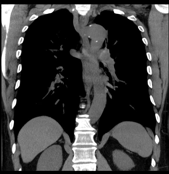 File:Aberrant right subclavian artery (Radiopaedia 40967-43680 Coronal non-contrast 22).jpg