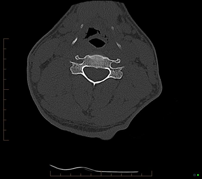 File:Accessory articulation of cervical transverse processes (Radiopaedia 82715-96933 Axial non-contrast 66).jpg