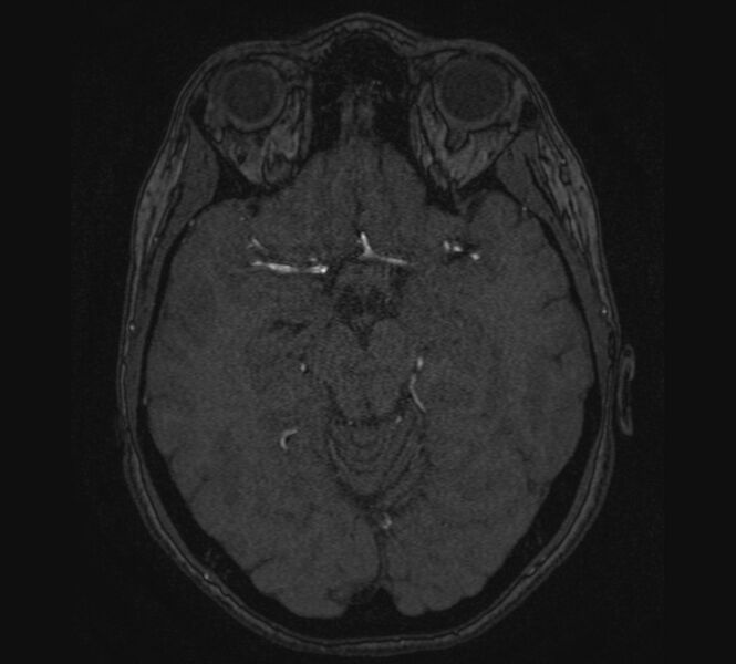 File:Accessory middle cerebral artery and ICA aneurysm (Radiopaedia 22656-22674 MRA 50).jpg