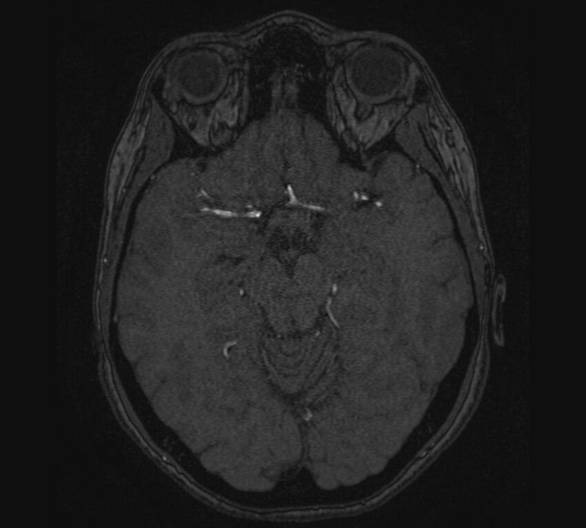 Accessory middle cerebral artery and ICA aneurysm (Radiopaedia 22656-22674 MRA 50).jpg
