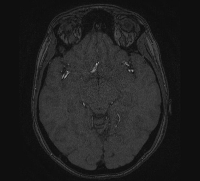 File:Accessory middle cerebral artery and ICA aneurysm (Radiopaedia 22656-22674 MRA 58).jpg