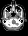 Accessory parotid glands (Radiopaedia 27289-27472 Axial non-contrast 15).jpg