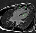 Active right ventricular cardiac sarcoidosis (Radiopaedia 55596-62103 4 CH PSIR 1).jpg