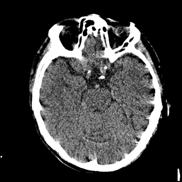File:Acute P1 occlusion with PCA ischemia penumbra (CT perfusion) (Radiopaedia 72084-82586 Axial non-contrast thins 3).jpg