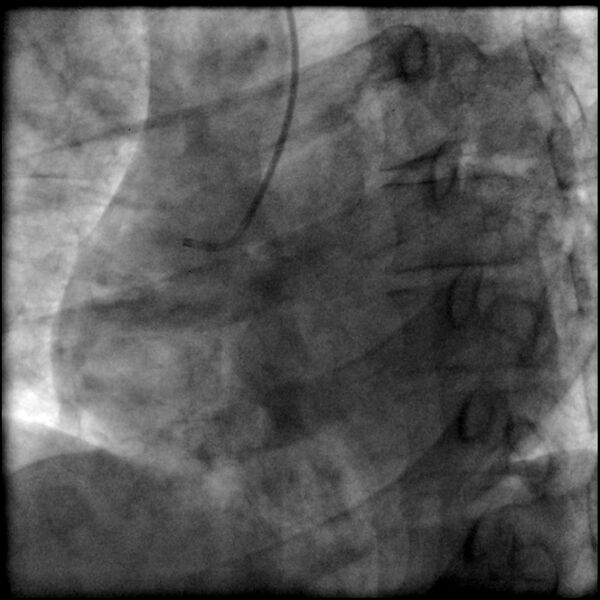 File:Acute anteroseptal myocardial infarction (Radiopaedia 68409-77946 RAO straight RCA 1).jpg