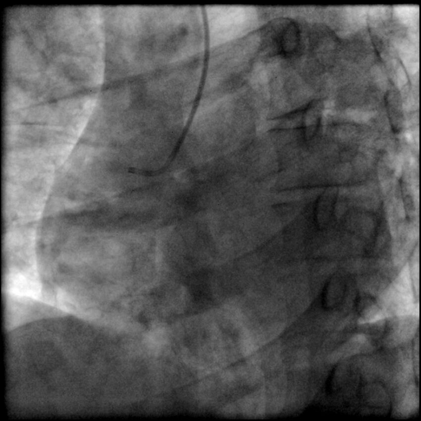 Acute anteroseptal myocardial infarction (Radiopaedia 68409-77946 RAO straight RCA 1).jpg