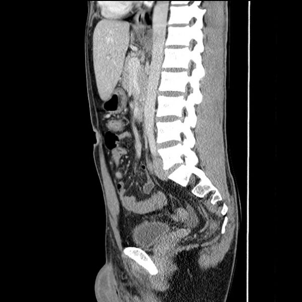 File:Acute appendicitis (Radiopaedia 27049-27227 Sagittal C+ portal venous phase 44).jpg