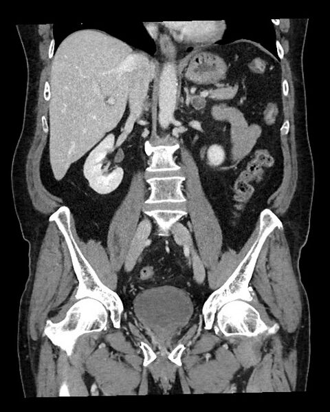 File:Acute appendicitis - large appendicoliths (Radiopaedia 61805-69820 Coronal C+ portal venous phase 74).jpg