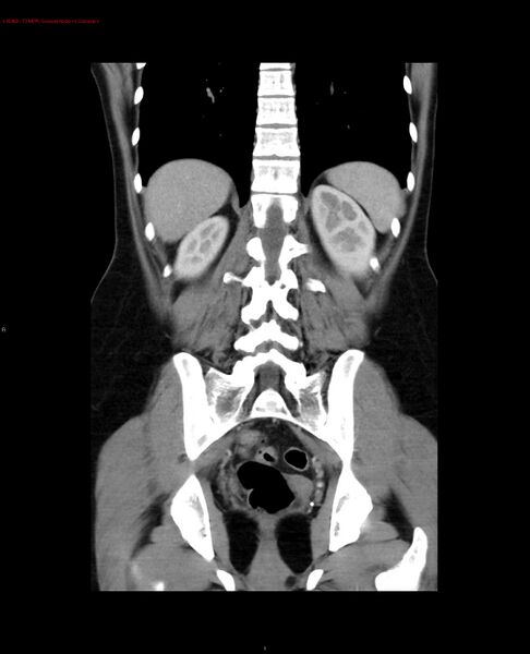 File:Acute gastritis (Radiopaedia 21043-20975 Coronal C+ portal venous phase 3).jpg