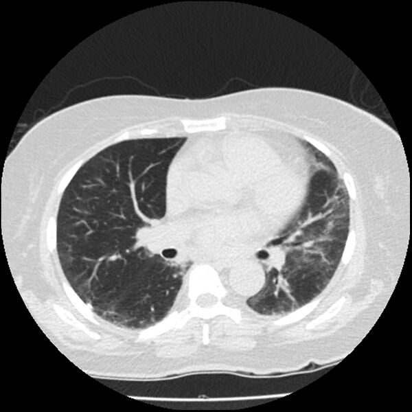 File:Acute interstitial pneumonitis (Radiopaedia 45404-49444 Axial lung window 55).jpg