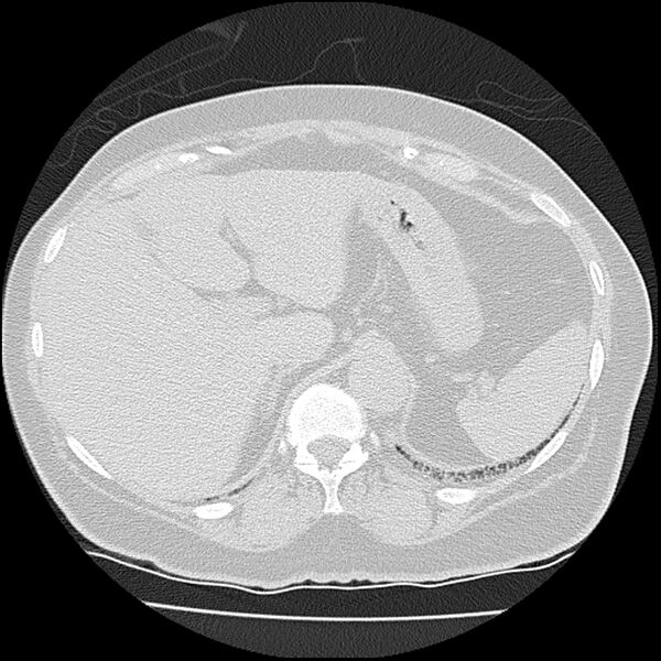File:Acute interstitial pneumonitis (Radiopaedia 45404-49452 Axial lung window 88).jpg