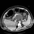 Acute pancreatic necrosis (Radiopaedia 13560-18502 Axial C+ portal venous phase 14).jpg