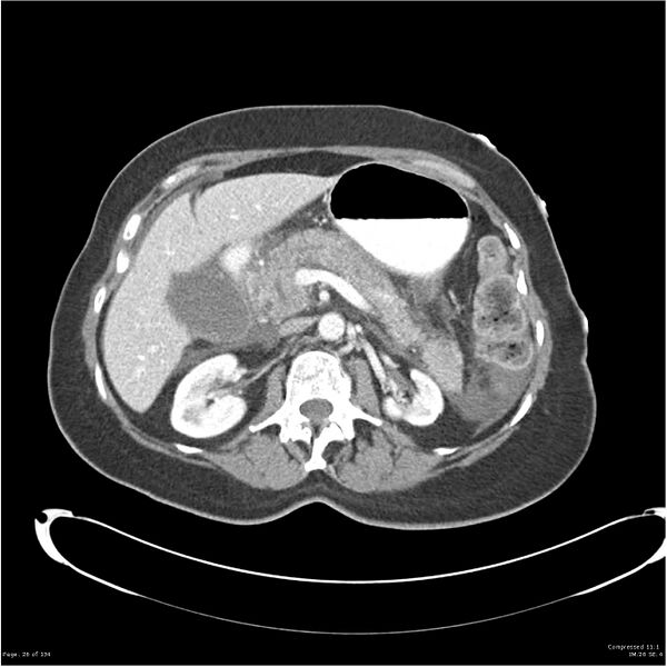 File:Acute pancreatitis (Radiopaedia 19136-19117 Axial C+ portal venous phase 13).jpg