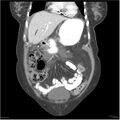 Acute pancreatitis (Radiopaedia 19136-19117 Coronal C+ portal venous phase 8).jpg