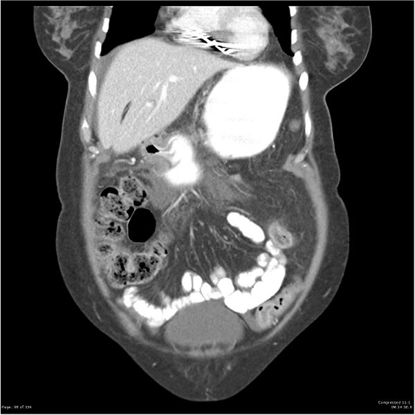 File:Acute pancreatitis (Radiopaedia 19136-19117 Coronal C+ portal venous phase 8).jpg