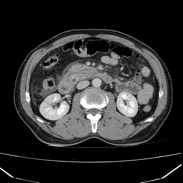 File:Acute pancreatitis (Radiopaedia 22572-22596 Axial C+ portal venous phase 32).jpg