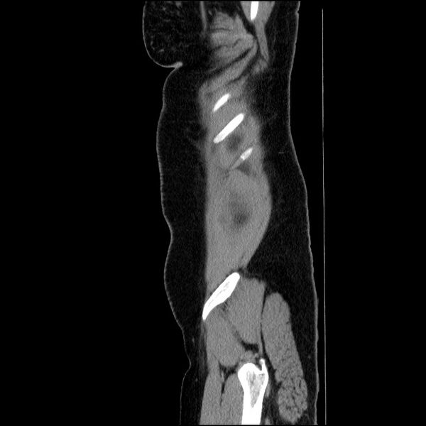 File:Acute pancreatitis (Radiopaedia 69236-79012 Sagittal C+ portal venous phase 18).jpg