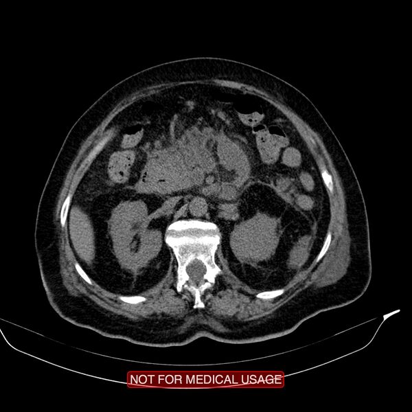 File:Acute pancreatitis with infected necrosis (Radiopaedia 26454-26585 Axial non-contrast 13).jpg