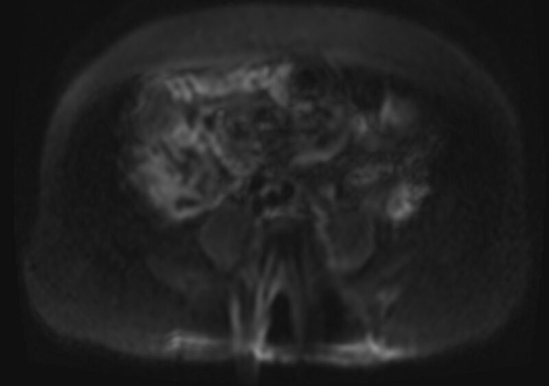 File:Acute portal vein thrombosis (Radiopaedia 73198-83925 Axial DWI 30).jpg