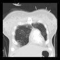 Acute pulmonary edema on CT (Radiopaedia 33582-34672 Coronal lung window 4).jpg