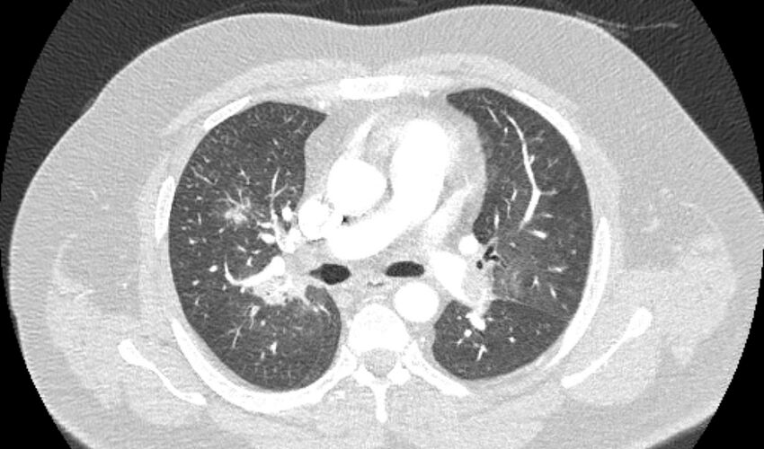 Acute pulmonary embolism with pulmonary infarcts (Radiopaedia 77688-89908 Axial lung window 47).jpg