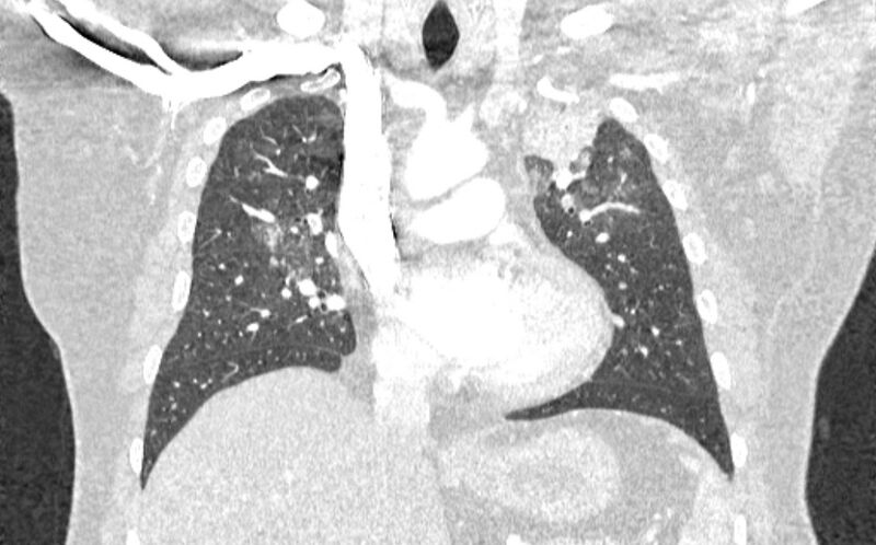 File:Acute pulmonary embolism with pulmonary infarcts (Radiopaedia 77688-89908 Coronal lung window 39).jpg