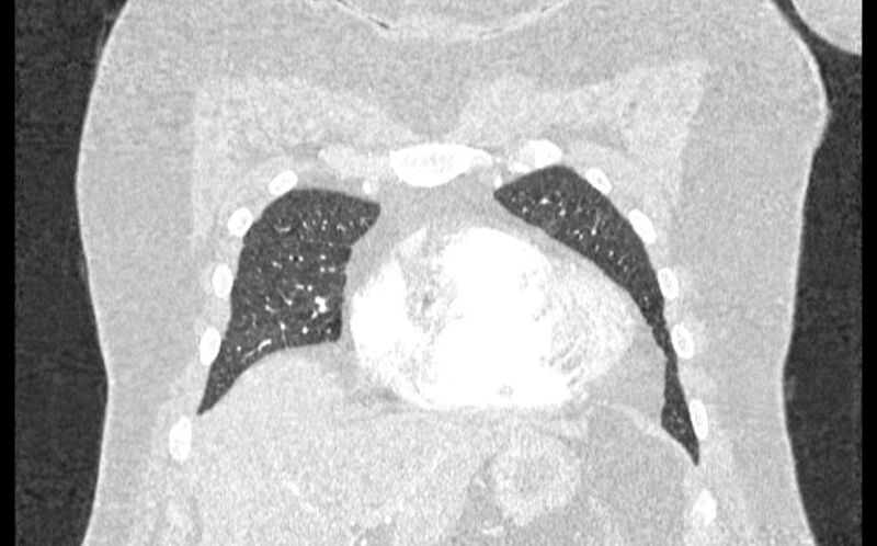 File:Acute pulmonary embolism with pulmonary infarcts (Radiopaedia 77688-89908 Coronal lung window 8).jpg