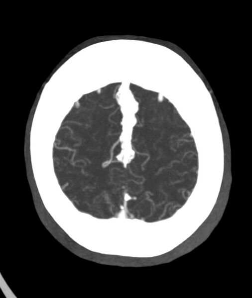 File:Acute right MCA M1 occlusion (Radiopaedia 62268-70454 Axial Phase 2 6).jpg