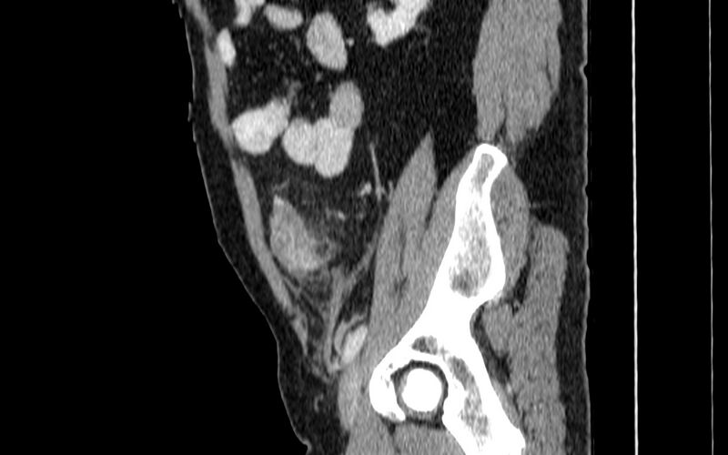 File:Acute sigmoid colon diverticulitis (Radiopaedia 55507-61976 Sagittal C+ portal venous phase 76).jpg