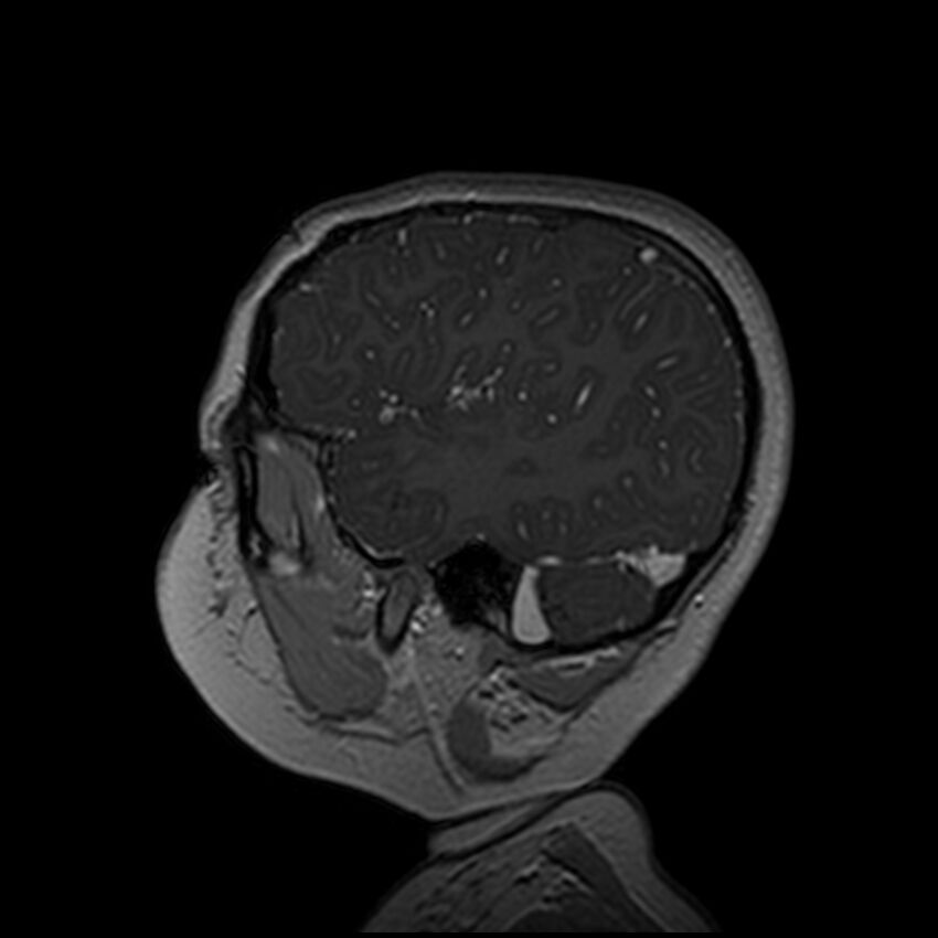 Adamantinomatous craniopharyngioma (Radiopaedia 77407-89529 H 24).jpg