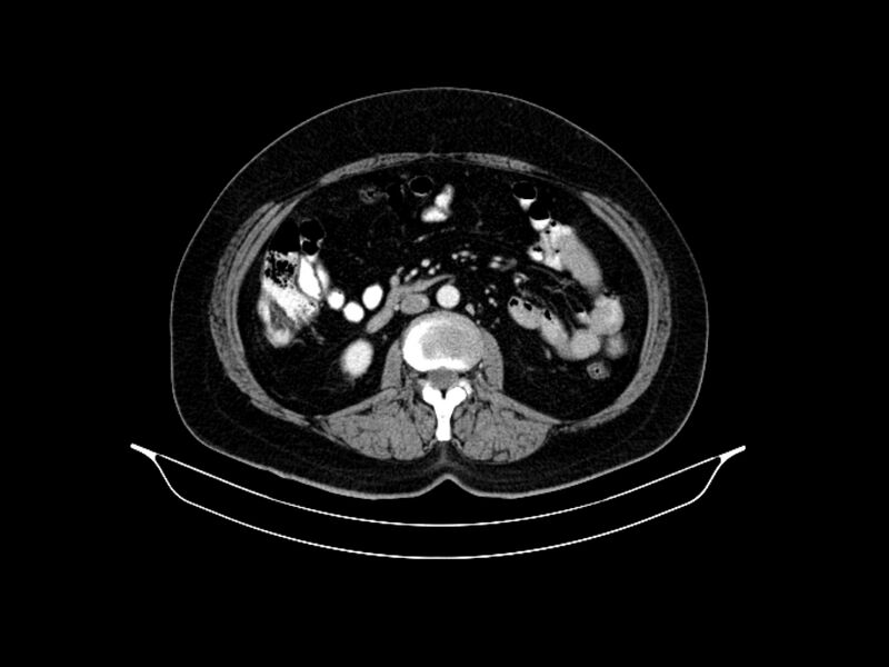 File:Adenocarcinoma of pancreas with hepatic metastasis (Radiopaedia 64332-73122 Axial C+ portal venous phase 52).jpg