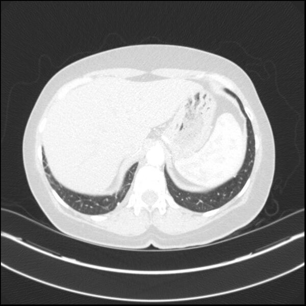 File:Adenocarcinoma of the lung (Radiopaedia 44205-47803 Axial lung window 80).jpg