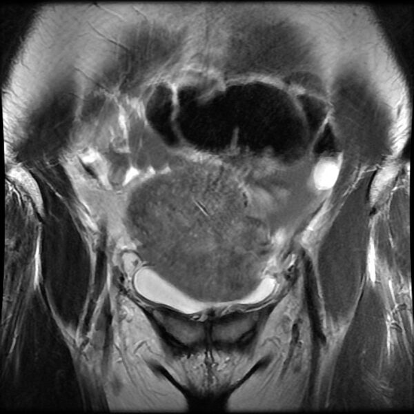 File:Adenomyosis on MRI (Radiopaedia 29328-29780 Coronal T2 14).jpg