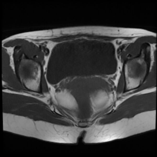 File:Adenomyosis within a septate uterus (Radiopaedia 69963-79981 Axial T1 19).jpg