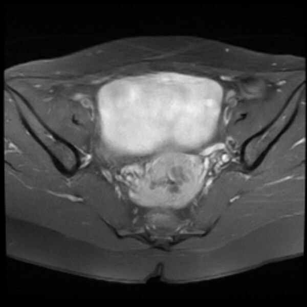 File:Adenomyosis within a septate uterus (Radiopaedia 69963-79981 Axial T1 C+ fat sat 14).jpg