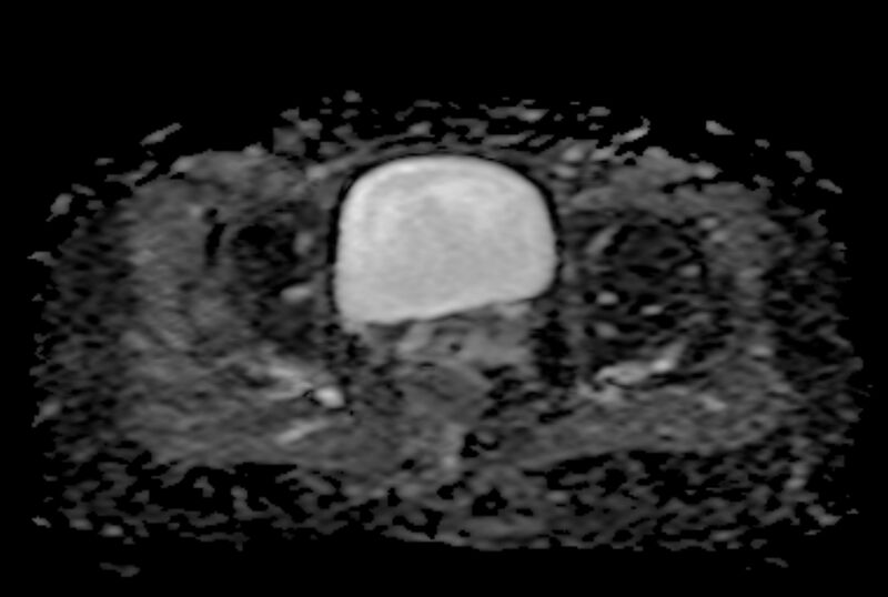 File:Adult granulosa cell tumor of the ovary (Radiopaedia 71581-81950 Axial ADC 20).jpg