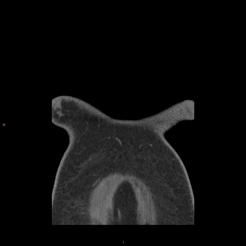 Agenesis of the left hepatic lobe (Radiopaedia 77284-89359 Coronal C+ CTPA 85).jpg