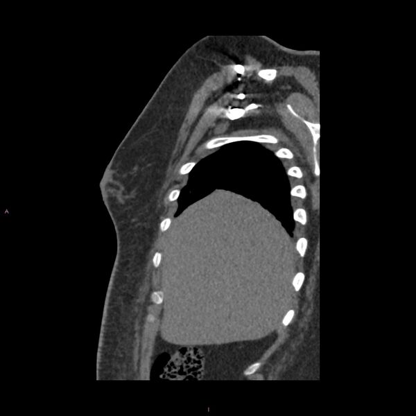 File:Agenesis of the left hepatic lobe (Radiopaedia 77284-89359 Sagittal C+ CTPA 13).jpg