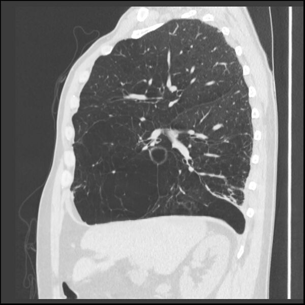 File:Alpha-1-antitrypsin deficiency (Radiopaedia 40993-43722 Sagittal lung window 179).jpg