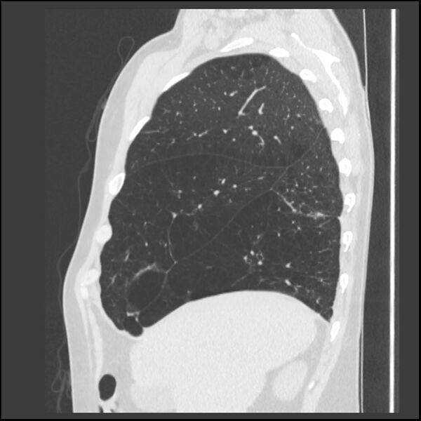 File:Alpha-1-antitrypsin deficiency (Radiopaedia 40993-43722 Sagittal lung window 215).jpg