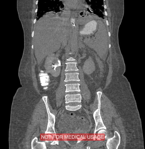 File:Amoebic enterocolitis with liver abscess (Radiopaedia 35100-36609 B 123).jpg